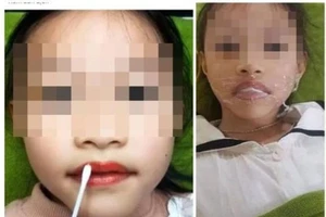 Hình ảnh bé gái năm tuổi bị phun môi thẩm mỹ lan truyền trên mạng. Ảnh: MXH 