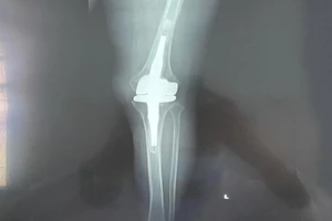Đặt khớp gối titanium từ Đức về Việt Nam để chữa cho bệnh nhân