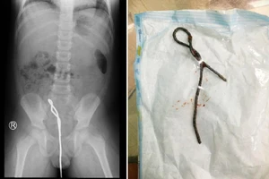 Học theo phim, bé trai nhét cây thông cống dài nửa mét vào hậu môn