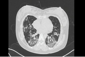 Hậu COVID-19, người phụ nữ 30 tuổi chưa đi nổi 10 bước oxy đã giảm 10%