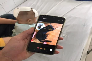 Bị chọc giận, chó cắn xuyên não bé gái 6 tháng tuổi