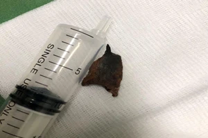 20 năm ho ra máu, mủ vì mảnh xương heo to bị bỏ quên trong phổi