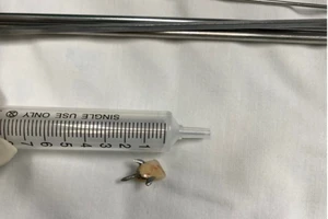 Súc miệng làm rơi răng giả, cô gái phải nhập viện cấp cứu