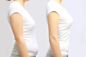 Gù lưng, lệch vai có thể chỉnh dáng được không?