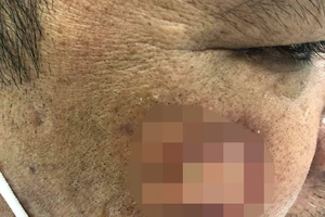 Tưởng bệnh về da, hóa ra bệnh tâm thần