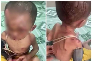Công an làm rõ vụ bé trai nghi bị bạo hành 