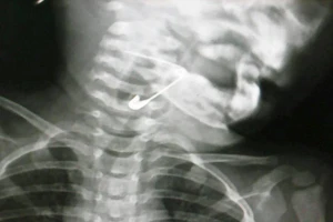 Lấy cây kim băng trong thực quản bé 18 tháng tuổi