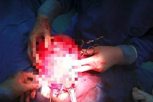 Cắt bỏ khối u gần 3 kg cứu sống nữ bệnh nhân