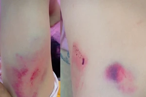 Không khởi tố vụ chánh văn phòng Huyện ủy đánh người 