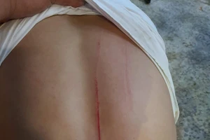 1 phóng viên bị chém nghi do báo tin liên quan đến gỗ lậu