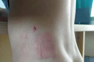 Chuyển công an huyện vụ bé 9 tuổi bị cha bạo hành