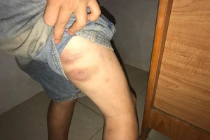 Công an vào cuộc vụ bé trai bị cha, bà nội đánh đập