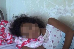 1 bé tử vong, 2 bé nhập viện nghi do ăn bưởi 