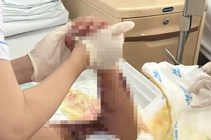 Nối thành công cánh tay đứt lìa của bé gái do bị cuốn vào máy giặt