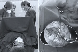 Mổ lấy khối u ‘khủng’ gần 2 kg cứu thai phụ và cháu bé