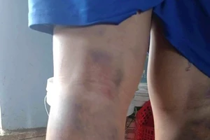 Cảnh cáo cô giáo đánh học sinh 2 chân bầm tím