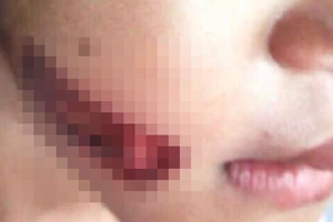 Khởi tố vụ bé 7 tuổi nghi bị gí sắt nóng vào người