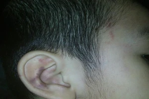 Đi học về, bé 5 tuổi sưng bầm tai nghi bị bảo mẫu đánh