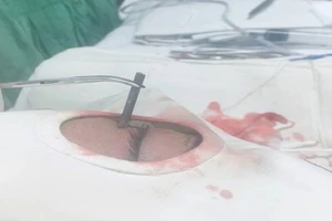 Sửa nhà ăn tết, người đàn ông suýt mù một mắt