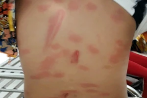 Tạm giữ người cha đánh con gái sáu tuổi bằng khúc sắt