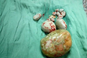 Phẫu thuật lấy viên sỏi 'khủng' cho cụ bà 84 tuổi