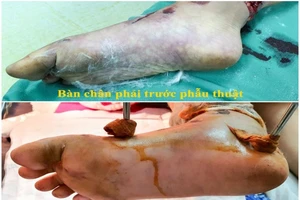 2 bệnh viện chạy đua cứu sống bàn chân bé gái