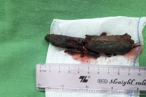 Chạy xe đạp vấp té, bé 8 tuổi bị khúc gỗ đâm xuyên mũi