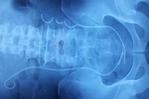 Ống thông đứt làm 3, bị 'bỏ quên' trong niệu quản suốt 3 năm