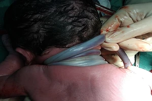 Cần Thơ: Bé trai chào đời với 4 vòng dây rốn quấn cổ