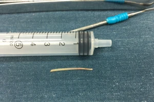 Lấy xương cá nằm trong thực quản bé gái suốt 5 tháng