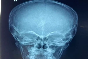 Chơi đùa, bé trai té ngã bị mảnh kính găm trong trán 2 ngày