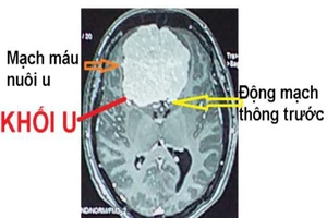 Khối u não khổng lồ. Ảnh: BVCC