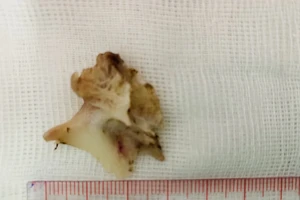 Hóc xương đầu cá, người đàn ông nhập viện cấp cứu