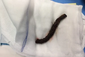 Trượt té, người đàn ông bị thanh sắt đâm xuyên đầu