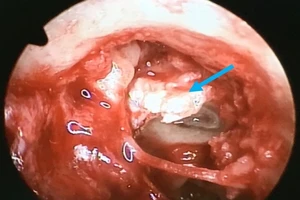 Bé gái bị khối cholesteatoma ăn mòn xương tai