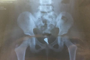 Gắp mặt dây chuyền nằm sâu trong âm đạo bé gái 5 tuổi