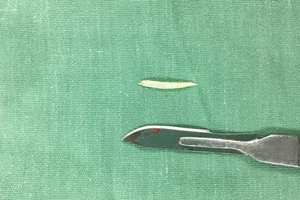 Hóc xương cá dứa, người phụ nữ nguy hiểm tính mạng