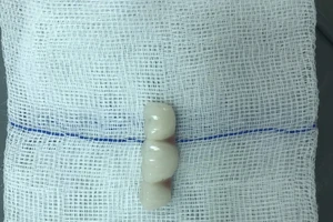 Ăn cơm, cụ bà nuốt luôn 4 răng giả mới lắp