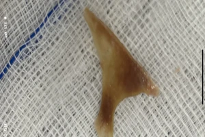 Ăn súp xương heo, cụ bà phải đi cấp cứu