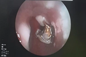 Ngủ dậy, phát hiện hàm răng giả đã 'chui tọt' vào phế quản