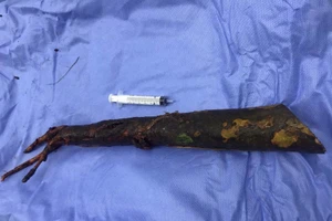 Người đàn ông bị cọc bần dài 80 cm đâm xuyên hạ vị 