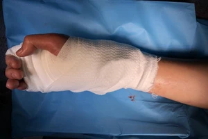 Nối bàn tay bị chém đứt lìa không cần chỉ khâu cho thiếu niên 17 tuổi