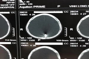 Trầm cảm thời gian dài, cụ ông 70 tuổi tự đóng đinh vào đầu