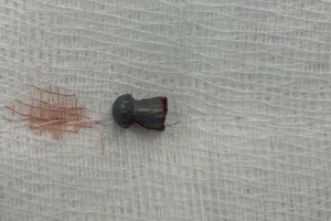 Đang làm lúa ngoài đồng, bất ngờ bị đạn lạc xuyên vùng kín