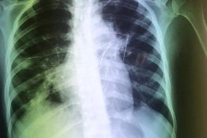 Stress do phát hiện nhiễm HIV, một phụ nữ tự đâm 7 cây kim vào ngực