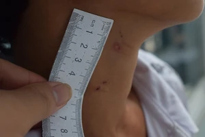 Vụ cha dượng hành hạ bé trai ở An Giang: Bộ phận sinh dục bị tổn thương nghiêm trọng