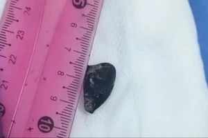 Hạt hồng xiêm bị bỏ quên hơn 10 năm trong phế quản