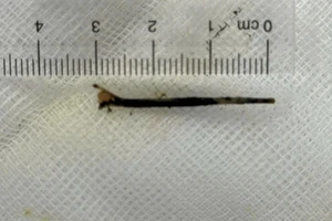 Nội soi lấy xương cá dài khoảng 3cm xuyên dạ dày vào đường mật của bệnh nhân