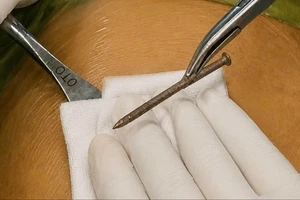 Cần Thơ: Dùng máy bắn đinh tại nhà, người đàn ông bị đinh xuyên vào ổ bụng