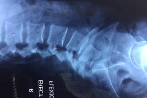 Phẫu thuật cột sống cho bệnh nhân nước ngoài